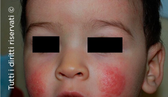 Atopic dermatitis