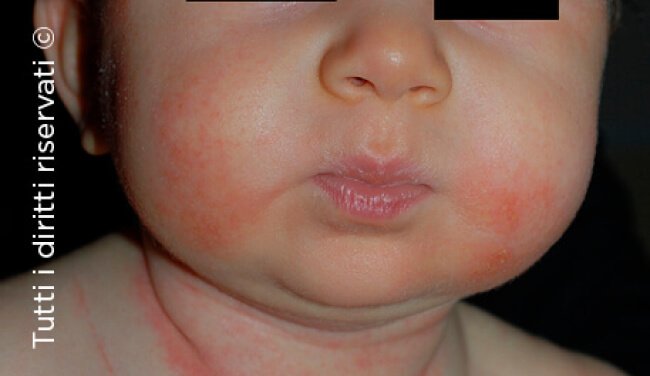 Atopic dermatitis