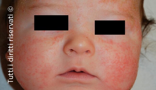 Atopic dermatitis