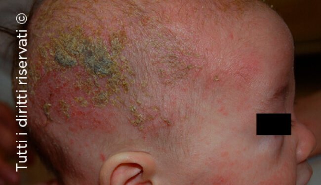 Atopic dermatitis