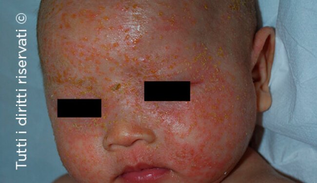 Atopic dermatitis