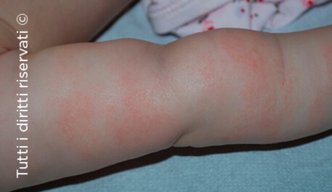 Atopic dermatitis
