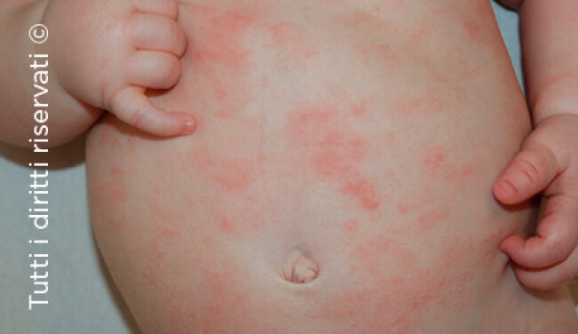Atopic dermatitis