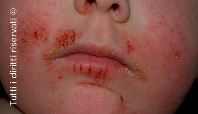Atopic dermatitis