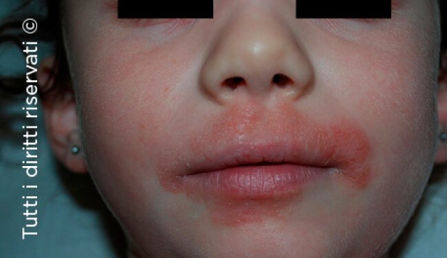 Atopic dermatitis