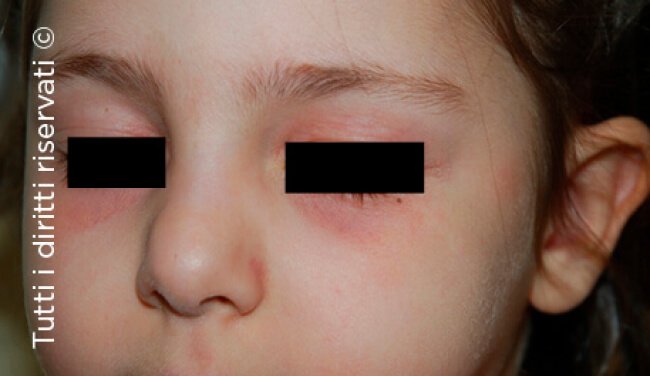 Atopic dermatitis