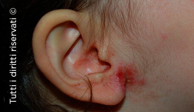Atopic dermatitis