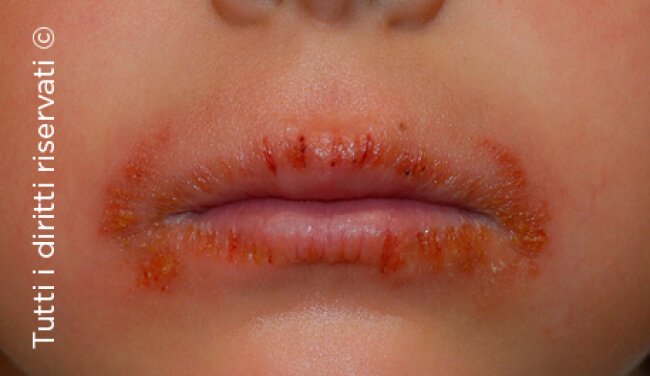 Atopic dermatitis