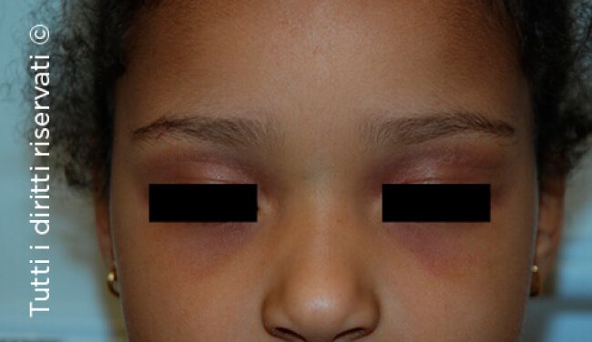 Atopic dermatitis