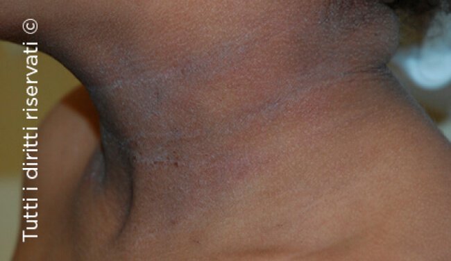 Atopic dermatitis