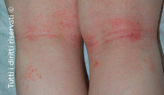 Atopic dermatitis