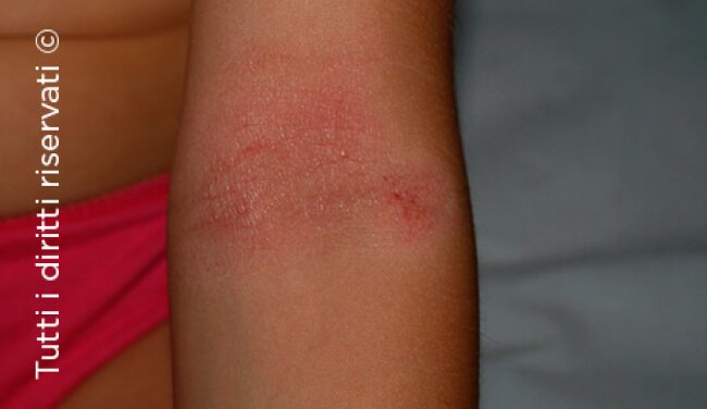 Atopic dermatitis