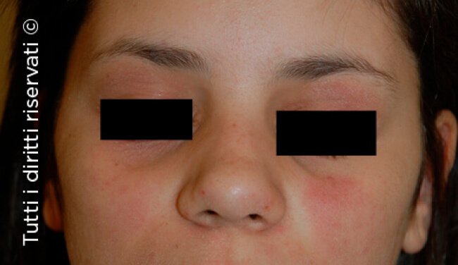 Atopic dermatitis