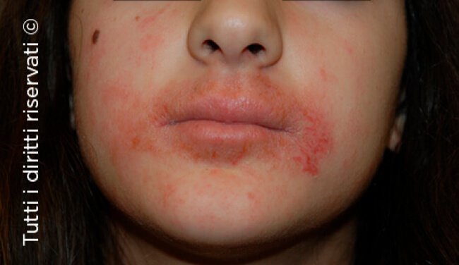 Atopic dermatitis