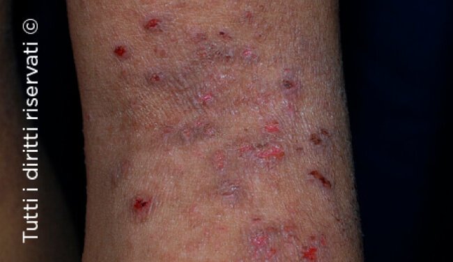 Atopic dermatitis