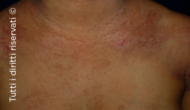 Atopic dermatitis