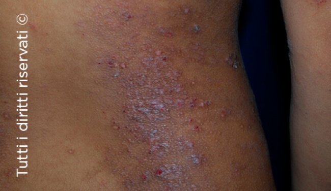 Atopic dermatitis