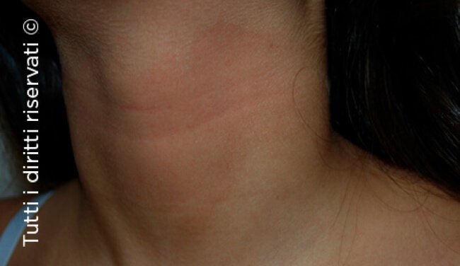 Atopic dermatitis