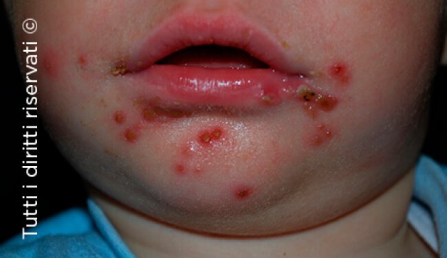 Herpes simplex