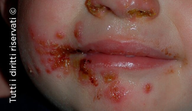 Herpes simplex