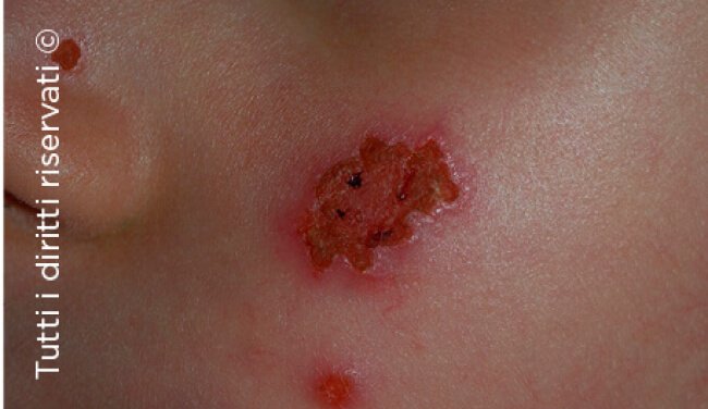 Herpes simplex