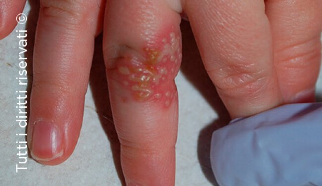 Herpes simplex