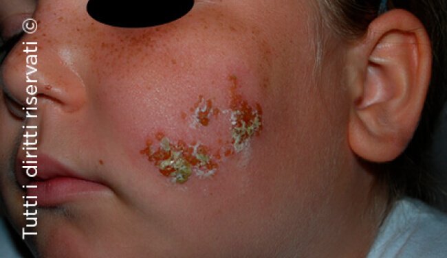 Herpes simplex