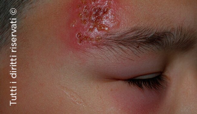 Herpes simplex