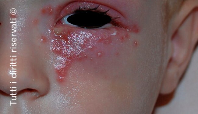 Herpes simplex
