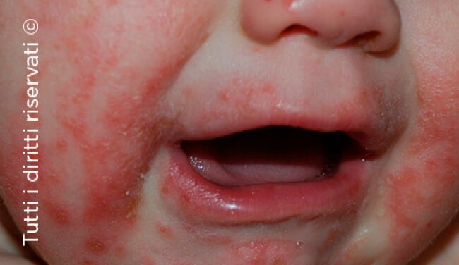 Herpes simplex