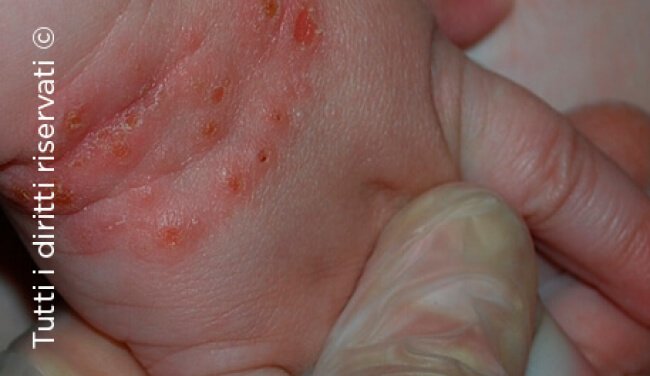 Herpes simplex