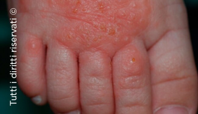 Herpes simplex