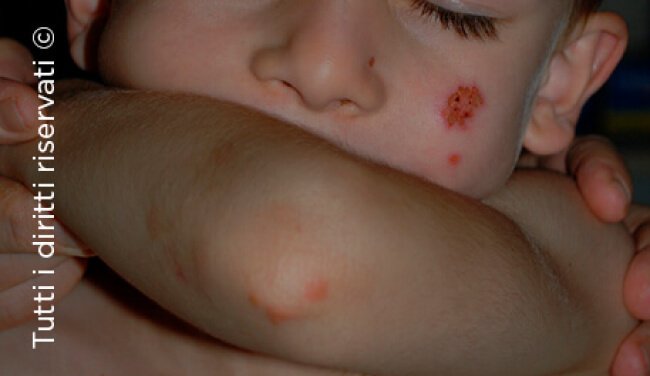 Herpes simplex