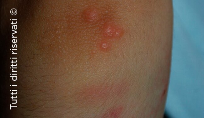 Herpes simplex