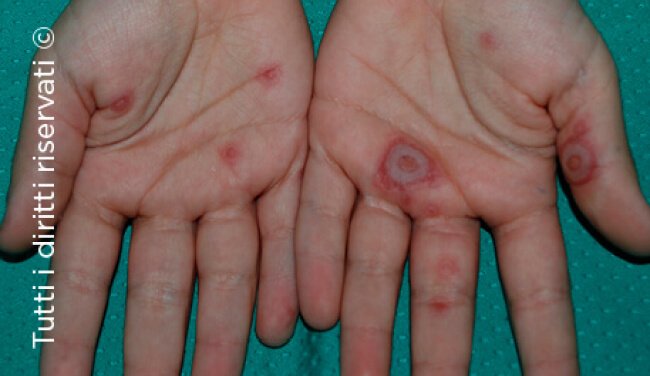 Herpes simplex