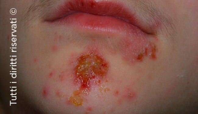 Herpes simplex