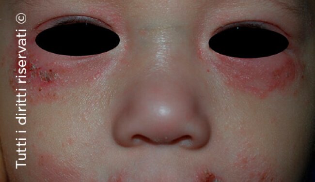 Herpes simplex