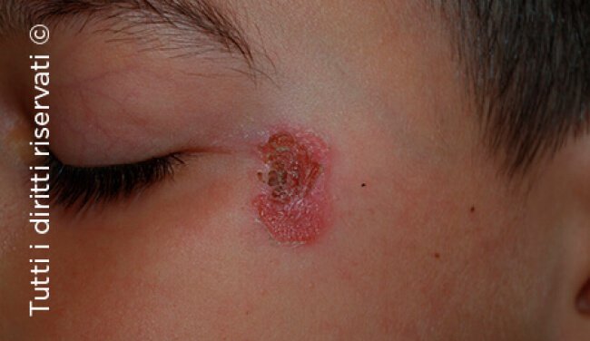 Impetigo