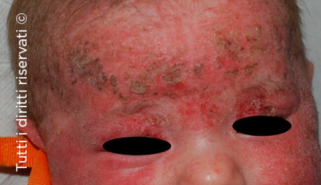 Impetigo
