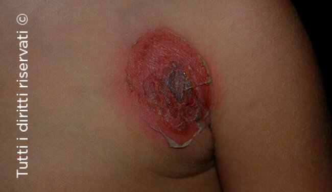 Impetigo
