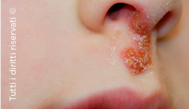 Impetigo