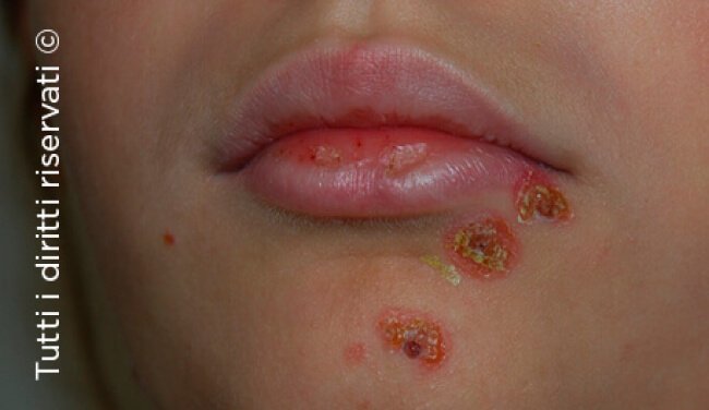 Impetigo