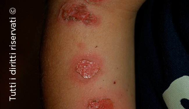 Impetigo