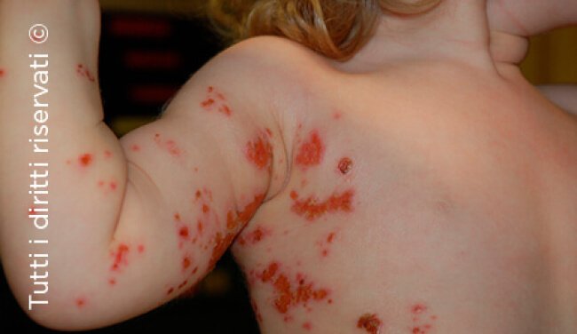 Impetigo