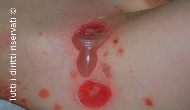Impetigo