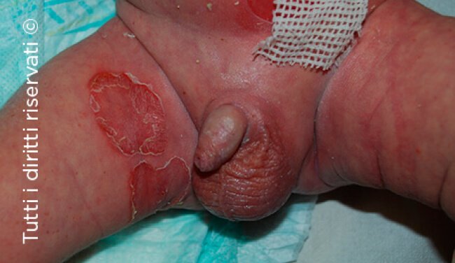Impetigo