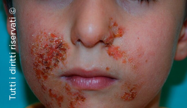Impetigo