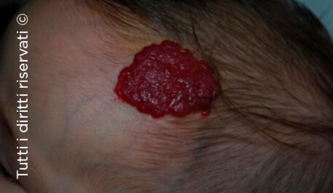 Infantile haemangioma