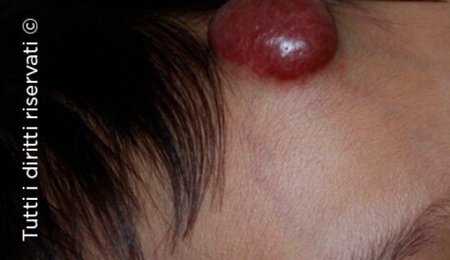Infantile haemangioma