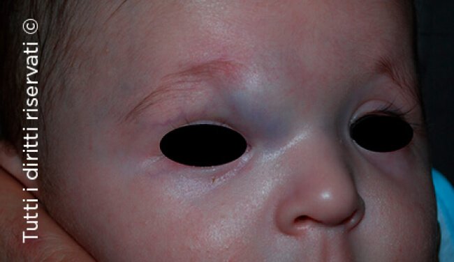 Infantile haemangioma
